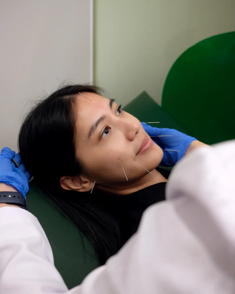 Acupuncture